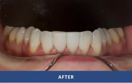 After Bioclear