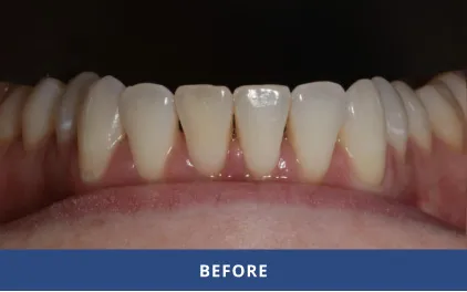 Before Bioclear